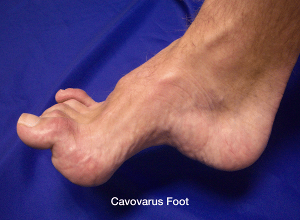 Cavovarus Foot
