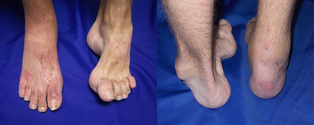 Foot After Surgery